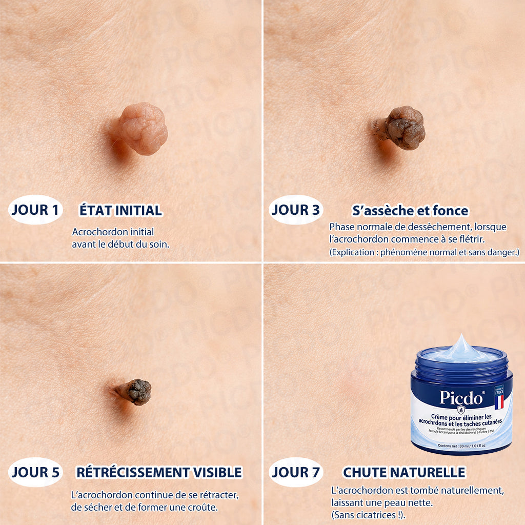 Picdo® Crème Correctrice Acrochordons & Taches — Action visible en 7 jours🌈
