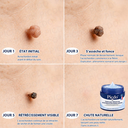 Picdo® Crème Correctrice Acrochordons & Taches — Action visible en 7 jours🌈