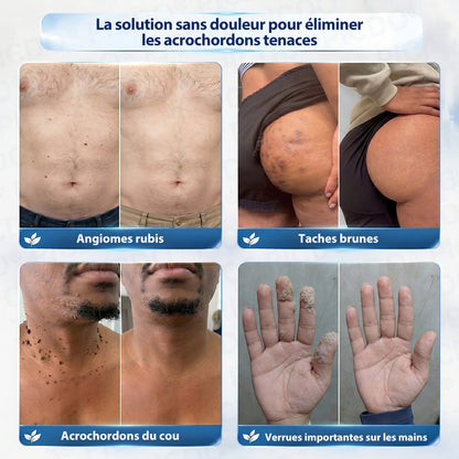Picdo® Crème Correctrice Acrochordons & Taches — Action visible en 7 jours🌈