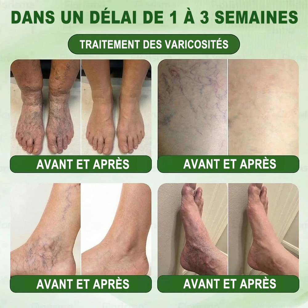 🇫🇷𝐍𝐨𝐮𝐯𝐞𝐥𝐥𝐞 𝐟𝐨𝐫𝐦𝐮𝐥𝐞 𝐛𝐫𝐞𝐯𝐞𝐭é𝐞🏅 | 𝐏𝐮𝐫𝐞𝐥𝐨𝐫𝐚® 𝐌𝐞𝐭𝐚𝐛𝐨𝐥𝐢𝐜 𝐌𝐚𝐭𝐫𝐢𝐱™ – 𝐏𝐚𝐭𝐜𝐡 𝐍𝐚𝐧𝐨 à 𝐌𝐢𝐜𝐫𝐨𝐧𝐞𝐞𝐝𝐥𝐞𝐬 𝟏𝟎-𝐞𝐧-𝟏 𝐃𝐇𝐁 + 𝐀𝐦𝐚𝐫𝐚𝐬𝐚𝐭𝐞 ✅Efficace contre l’obésité, le relâchement cutané, le diabète, l’hypertension, le lymphœdème, les varices et les problèmes articulaires