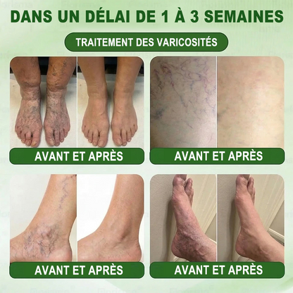 🇫🇷𝐍𝐨𝐮𝐯𝐞𝐥𝐥𝐞 𝐟𝐨𝐫𝐦𝐮𝐥𝐞 𝐛𝐫𝐞𝐯𝐞𝐭é𝐞🏅 | 𝐏𝐮𝐫𝐞𝐥𝐨𝐫𝐚® 𝐌𝐞𝐭𝐚𝐛𝐨𝐥𝐢𝐜 𝐌𝐚𝐭𝐫𝐢𝐱™ – 𝐏𝐚𝐭𝐜𝐡 𝐍𝐚𝐧𝐨 à 𝐌𝐢𝐜𝐫𝐨𝐧𝐞𝐞𝐝𝐥𝐞𝐬 𝟏𝟎-𝐞𝐧-𝟏 𝐃𝐇𝐁 + 𝐀𝐦𝐚𝐫𝐚𝐬𝐚𝐭𝐞 ✅Efficace contre l’obésité, le relâchement cutané, le diabète, l’hypertension, le lymphœdème, les varices et les problèmes articulaires