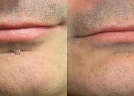 ✨Curalona® Patch micro-aiguilles et hydrocolloïde 2 en 1🍀 | Élimine les grains de beauté en relief, l'acné, les verrues planes et les acrochordons | Atténue les rides, les cicatrices et les imperfections | Patchs invisibles pour le visage et le corps